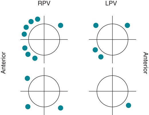 Spatial distribution of PV reconduction gaps in group CB2.