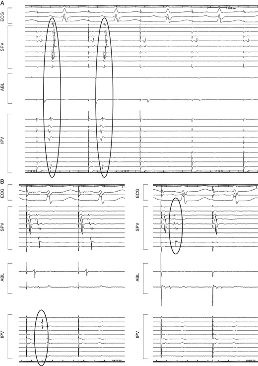 Intracardiac tracings exhibiting different disappearance patterns of the PVPs during PV isolation. (A) All PVPs disappeared simultaneously in both the superior and inferior PVs during EPVI. (B) The inferior and superior PVPs disappeared separately during EPVI. ABL, ablation catheter; ECG, electrocardiogram; EPVI, extensive pulmonary vein isolation; IPV, inferior pulmonary vein; PV, pulmonary vein; PVPs, pulmonar vein potentials; SPV, superior pulmonary vein.