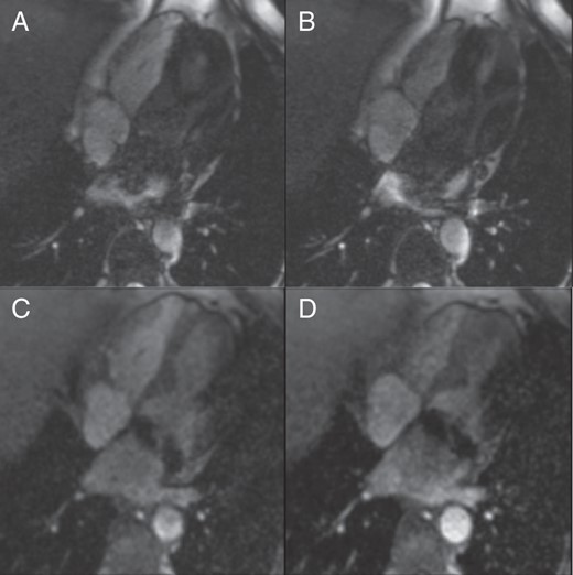 Kinetic study in four-chamber view: The systolic (A and C) and diastolic (B and D) images of cine sequences, four-chamber view. The steady-state free precession (SSFP) sequence (A and B) shows more artefacts. The patient underwent mitral valve repair with a metallic ring implantation. In SSFP kinetic study, an inflow of dark blood from the left pulmonary veins was seen. It could be caused by S-ICD but also by metallic ring in mitral annulus. The spoiled gradient echo (GRE) sequence (C and D) is better, but an artefact at the lateral wall is obvious.