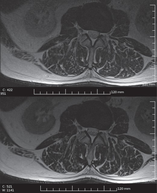 Lumbar spine imaging with ICD: low SAR T2 FSE sequence (upper image) compared with normal T2 FSE in the same subject (lower image, for the scanning parameters see the Discussion section).