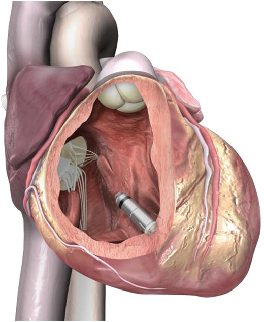Micra inside right ventricle.