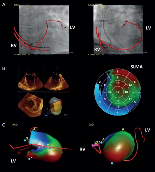 Methods. Three-dimensional (3D) evaluation and integration of the relationship between the LV lead position and the LV wall motion in CRT non-responders. (A) Fluoroscopic rotation scan showing the ventricular lead courses. (B) Real-time three-dimensional echocardiography with analysis of LV wall motion. (C) Integration of both investigations into one single 3D model. LAO, left anterior oblique projection; LV, left ventricular lead; RAO, right anterior oblique projection; RV, right ventricular lead; SLMA, site of latest mechanical activation; pink dots with numbers = integration landmarks of (A) and (B).