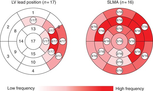 Distribution of the LV lead position and SLMA over all patients. Re-production of the 17-segment model of the LV, showing a classically implanted LV lead position and a widespread SLMA, mostly affecting anteroseptal to anterolateral and inferolateral parts of the LV. LV, left ventricular; SLMA, site of latest mechanical activation.