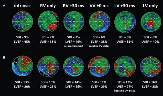 Re-programming of the VV delay. Analysis of LV wall motion, LV dyssynchrony (SDI), and LVEF for different VV-delay re-programming displayed on the 17-segment model of the LV in a colour-coded fashion with blue, red, and green indicating early, late, and synchronized activation, respectively. (A) Patient (No. 5) showing improved LV wall motion, SDI, and LVEF under a VV-delay re-programming to RV +30 ms. (B) Patient (No. 13) showing no improvement with remaining high SDI and poor LVEF. Intrinsic = intrinsic AV-nodal conduction; LV/RV only = univentricular left/right stimulation; VV ±0 ms = biventricular simultaneous stimulation; LV/RV +30 ms = biventricular stimulation with left/right ventricular pre-activation of 30 ms. LV, left ventricular; LVEF, left ventricular ejection fraction; SDI, systolic dyssynchrony index; VV, interventricular.
