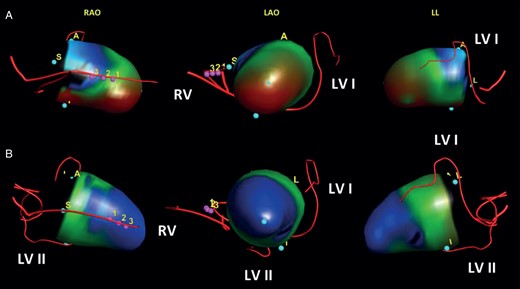 Implantation of a second LV lead. Integrated 3D models of the left ventricle, showing LV wall motion before and after implantation of a second LV lead. (A) Patient (No. 13) presenting with a discordant LV lead at a mid-ventricular lateral position and SLMA on the entire inferior LV wall during intrinsic atrioventricular-nodal conduction (SDI, 13%). (B) Same patient (No. 13) after implantation of a second LV lead to the inferior SLMA showing resynchronized LV wall motion and improved LV dyssynchrony (SDI, 5%). LAO, left anterior oblique projection; LL, left lateral projection; LV, left ventricular; LV I, previously implanted first LV lead; LV II, newly implanted second LV lead; RAO, right anterior oblique projection; RV, right ventricular lead; SDI, systolic dyssynchrony index; SLMA, site of latest mechanical activation; pink dots with numbers = integration landmarks.