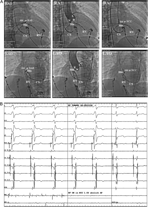 (A) Fluoroscopic images from the case No. 6 who was firstly got failed ablation from the right atrial septum (RAS), and then the ablation target were changed to the NCC and successfully ablated the AP. Left: catheter location at the RAS ablation site in the right anterior oblique (RAO) and left anterior oblique (LAO) views. Middle: aortic root angiograms taken from a pigtail catheter at the NCC at the same fluoroscopic angles before ablation at the NCC. Right: the successful ablation site was located at the NCC. (B) Intra-cardiac electrograms of the successful ablation target at the NCC. Radiofrequency catheter ablation at the NCC successfully ablated the AP. Abl, ablation catheter; RAS, right anterior septum; CS, coronary sinus; RV, right ventricle; RVA, RV apex. L, left coronary cusp; N, non-coronary cusp; R, right coronary cusp; RF, radiofrequency; AP, accessory pathway.