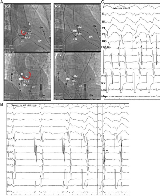 (A) Fluoroscopic images from the case No. 11 who was firstly ablated at the NCC and successfully ablated the AP. Left: aortic root angiograms taken from a pigtail catheter at the same fluoroscopic angles before ablation at the NCC in the RAO and LAO views. Right: the successful ablation site was located at the NCC. (B) Intra-cardiac electrograms of the successful ablation target at the NCC, ventricular pacing showed the retrograde A was at the same line with the His bundle A. (C) Following ablation, ventricular pacing showed retrograde VA Wenckebach block, confirmed the successful ablation of retrograde AP. And the last paced V is conducted to A using an atrioventricular node which was suggested by the longer VA interval and change in the sequence of retrograde A activation. Abl, ablation catheter; CS, coronary sinus; RV, right ventricle; RVA, RV apex. L, left coronary cusp; N, non-coronary cusp; R, right coronary cusp; AP, accessory pathway.