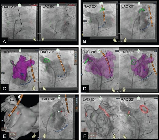 Representative periprocedural CARTO-UNIVU (cU) images during AF ablation. (A) cU display of pseudo biplane X-ray images in RAO 20° and LAO 60° recorded with a monoplane fluoroscopy system; diagnostic catheters in right ventricular apex and coronary sinus, trans-septal sheath and oesophageal temperature probe are shown. (B) cU display of pseudo biplane angiography of the left atrium (LA) including the pulmonary veins; active cU tracking of the CS catheter (blue), the temperature probe (orange) and the spiral mapping chatheter (green) which is positioned in the left superior pulmonary vein. (C) Left panel active cU tracking of catheters within the angiography of the LA and overlay of a part of the corresponding EAM including substrate mapping (purple colour encodes healthy myocardium); right panel display simultaneously to the left panel the pseudo biplane angiography in LAO view with active cU catheter tracking; the spiral catheter is positioned in the right superior pulmonary vein. (D) Angiography of the LA and overlay of the EAM including substrate mapping in pseudo-biplane view. (E) Start of the PVI, the left panel shows the EAM without substrate mapping in PA view; the temperature probe (orange) and the tip ablation catheter (red tip) are displayed; the first ablation point which was acquired with automated point acquisition tool (VISITAG) is displayed, the left plane shows the corresponding angiography in LAO view with active cU catheter tracking and the first ablation point. (F) Pseudo-biplane view of the LA angiography with the EAM as overlay (high transparency) and active cU tracking of the ablation catheter, the isolation of the left pulmonary veins is finished and the isolation of the right veins is started (all ablation points were taken with VISITAG).