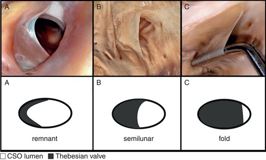 Photograph of cadaveric heart specimens and schematic pictures with examples of: (A) Type I of TV—remnant; (B) Type II of TV—semilunar; (C) Type III of TV—fold.