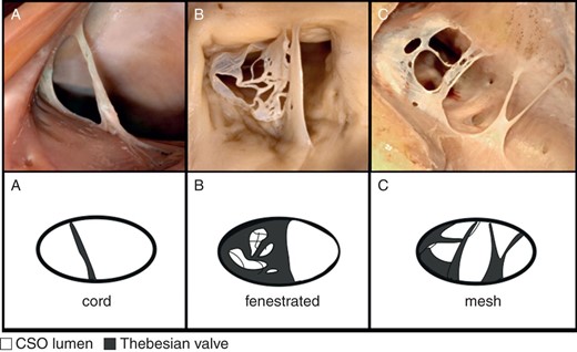 Photograph of cadaveric heart specimens and schematic pictures with examples of: (A) Type IV of TV—cord; (B), (C) Type V of TV—mesh and fenestrated.