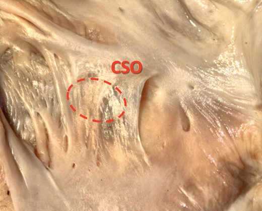 Photograph of cadaveric heart specimen showing a TV (Type III—fold) which covers the whole coronary sinus ostium (CSO), going well beyond the CSO contour.