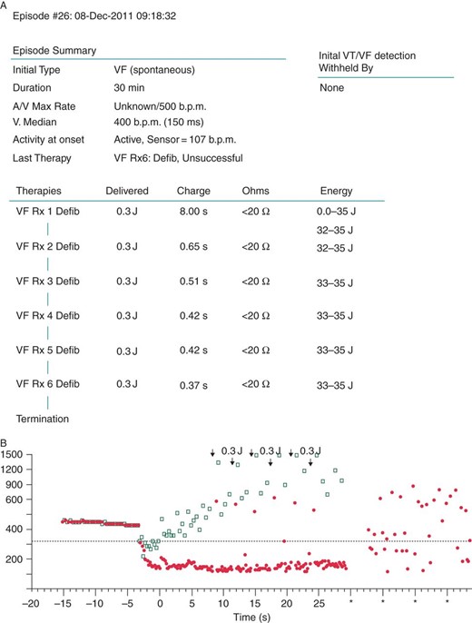 (A) Episode summary revealed that VF detection occurred; however, the capacitors were charged to 32–35 J, but only 0.3 J was delivered due to the excessive current protection system. (B) Ventricular fibrillation could not be terminated by 0.3 J shocks (black arrows) and it continued for 30 min.