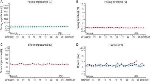 According to the Cardio Messenger Home Monitoring System, the last data were sent at 0:53 in May 2012. No abnormality was detected in the following: (A) pacing impedance (Ω), (B) pacing threshold (V), (C) shock impedance (Ω), or (D) R wave (mV).