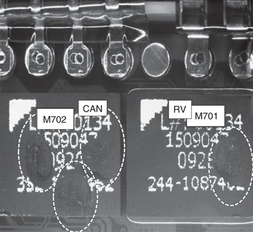 In an explanted Lumax 540-DR, the output switch circuits of both the can (three left circles) and RV lead (right circle) were partially melted. This phenomenon indicated electrical overload from abnormal temporary high current along the component of the electrical circuit. In this case, the origin of the high current was not clear. The surface of the ICD was intact, and further analysis by Biotronik showed that the device was free of short circuits in the shock path. There was highly unlikely of an intra-pocket short circuit, because there was no arc mark on the surface of the device. Therefore, it was assumed that an external short circuit had taken place within the leads during delivery of shock therapy that damaged the ICD.