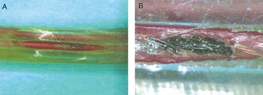 (A) An extracted ICD lead showed partial insulation defect that developed from arc discharge. (B) The lead failure occurred not only on the silicone outer insulation, but also on the ETFE of the RV coil conductor.