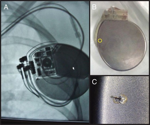 (A) A preoperative X-ray revealed no significant abnormalities in either lead. However, multiple burns and areas of bleeding were found within the excised ICD pocket during operation. We found a surface arc mark on the back of generator, which suggests a HV electrical short circuit (B and C). The arc mark was due to stimulation from outside the body, because an injury did not occur inside the body. On the X-ray, the arc mark was located near the slit in the ICD lead, while far from the slit in the atrial lead. Moreover, the generator could not be destroyed due to an artificial slit in the atrial lead during a bench test. Thus, we concluded the arc mark was due to ICD lead failure.