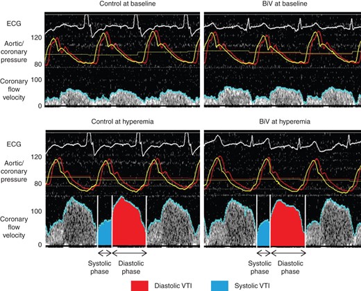 Representative case of coronary flow velocity and pressure measurements in the left anterior descending coronary artery at each condition. We have defined average peak velocity, diastolic velocity, systolic velocity, diastolic time, systolic time, diastolic velocity time integral (VTI), and systolic VTI. Control indicates atrial pacing in patients with left bundle-branch block or sequential atrial and right ventricular pacing in patients with complete atrioventricular block, and biventricular pacing (BiV) indicates sequential atrial and biventricular pacing. Red line indicates aortic pressure; yellow line, coronary pressure; blue line, coronary flow velocity. ECG, electrocardiogram.