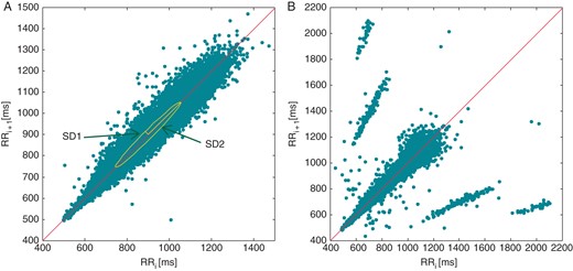 Traditional parameters obtained from a Poincaré plot (A). SD1 and SD1 are mathematically equivalent to linear HRV indices (‘Poincaré plot analysis’ section in Appendix). Poincaré plots are effective in detecting errors in the labelling procedure, ectopic beats, or other rhythm abnormalities as shown in (B).