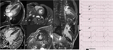 fQRS complexes and LGE on CMRI