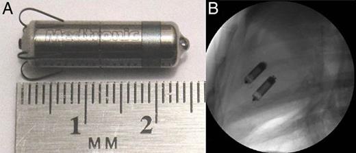Micra device and fluoroscopic imaging with Micra devices: (A) an example of the Micra device and (B) fluoroscopic imaging of two Micra devices implanted in the RV.