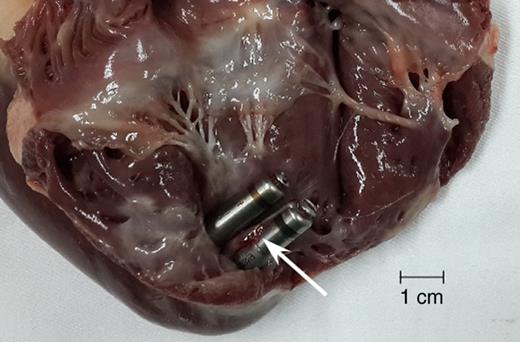 Fibrous tissue attaching around Micra devices observed at necropsy. Arrow indicates the fibrous tissue attachment.