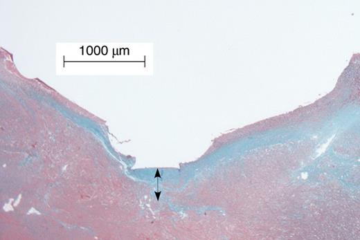 Tissue fibrosis beneath the Micra pacing electrode. Arrow indicates the thickness of the fibrosis measured from the endocardium where the device was placed.
