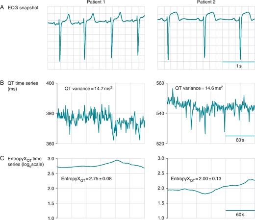 Sample tracings of EntropyXQT. Baseline data from two patients are shown, including a 3-s ECG segment (A), horizontal time axis 0.2 s/box, and corresponding time series (30 s/box) for the QT interval (B) and EntropyXQT (C). The QT variances were 14.7 and 14.6 ms2 in the left and right panels, respectively. EntropyXQT was used to quantify the distinct patterns underlying the variability of the QT time series and yielded values (mean ± SD) of 2.75 ± 0.080 (left panel) and 2.00 ± 0.131 (right).