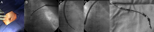 (A) Preprocedural appearance of pacemaker pocket which showing the erosion of ICD generator and lead out of the pocket. (B) Fluoroscopic view of ICD electrode covered by the TightRail™ sheath. (C, D) After the fibrous adhesions were eliminated by the cutting tip of TightRail™ sheath, ICD electrode was pulled back into the sheath and extracted successfully. (E) Fibrous material adherent to defibrillator coil at multiple sites.