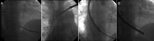 (A) Fluoroscopic view of the atrial and defibrillator leads before extraction of dysfunctional defibrillator lead. (B, C and D) Defibrillator lead was covered by the TightRail™ system and extracted successfully without any damage or wrapping of the coexistent atrial lead.