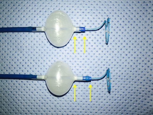 The figure shows the difference between second- and third-generation CBs: with respect to the former CB-A (below), the CB-ST (above) has been designed with a 40% shortened tip length (yellow arrows).