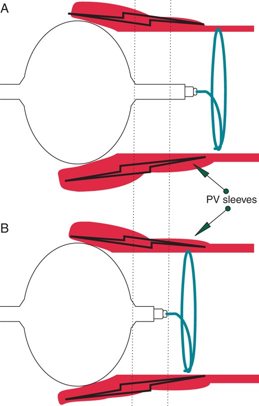 (A) In the CB-A ablation procedures, the ILMC was often positioned more distally to the PV sleeve extension in order to offer stability to the balloon catheter in the PV ostium. In addition, the catheters shaft extended 1 cm beyond the balloon tip, creating a distance between the ILMC and the site of ablation. (B) The shortened tip length has greatly shortened the distance between the ablation site and the ILMC position resulting in a higher probability of the Achieve catheter being in contact with the PV sleeves and therefore providing important electrical information on the effects of ablation in that vein.