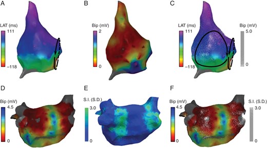 Dot mapping atrial cases. (A and B) Right atrial maps showing local activation time and bipolar electrogram voltage, respectively. (C) Combined dot map showing local activation time (colour isochrones) and bipolar voltage (dots). (D and E) Post-ablation left atrial maps showing bipolar electrogram voltage and CMR LGE signal intensity, respectively. (F) Combined dot map showing bipolar electrogram voltage (colour) and CMR LGE signal intensity (dots).