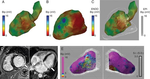 Dot mapping ventricular cases. (A and B) Left ventricular bipolar electrogram voltage maps for endocardial and epicardial shells, respectively. (C) Combined left ventricular bipolar electrogram voltage maps showing endocardial voltage (colour) and epicardial voltage (dots). (D) CMR LGE showing scar in the mid to basal inferolateral wall. (E) Combined dot map showing bipolar electrogram voltage (colour) and CMR LGE (dots).