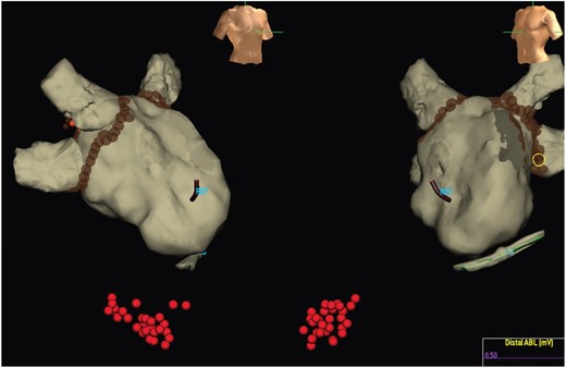 Ablation strategy. All patients in the Registry underwent PVI which resulted in termination of AF. Additional ablation for atrial arrhythmia with AF termination was permitted as was placement of a cavotricuspid isthmus linear lesion in sinus rhythm. In this example, PVI and cavotricuspid isthmus ablation was performed.