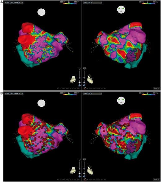 (A) A left atrial bipolar voltage map showing extensive low-voltage areas defined as <0.5 mV; regions in red show scar and other colored regions represent abnormal myocardium, purple regions represent normal myocardium. (B) Ablation points (red dots) illustrating the scar homogenization approach.