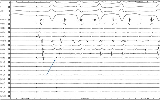 Representative intracardiac electrogram showing a trigger from the coronary sinus in one of the patients included in the analysis; the Lasso is positioned in the LA appendage and shows premature atrial contractions (arrow) during isoproterenol challenge.
