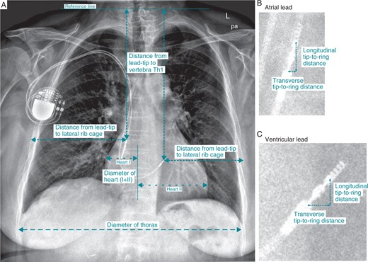 Input variables for the regression analyses obtained from PA chest radiography of the patients. The measurement technique is depicted for the following variables: diameter of the heart and thorax, distance from the lead-tip to the vertebra Th1 and to the lateral rib cage (A), as well as distance between the tip and the ring along the transverse and longitudinal axis (B for the atrial lead and C for the ventricular lead).