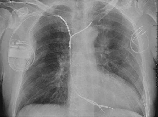 Implantable cardioverter defibrillator generator implant on the right side with abandoned ICD lead on the left side.