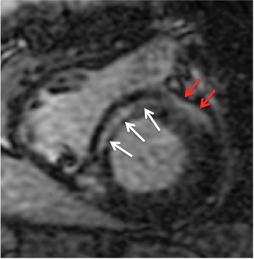 Short-axis view of the basal left and right ventricles of a patient with non-ischaemic cardiomyopathy. White arrows indicate the location of an intramural septal scar. Red arrows indicate artefact that is projected on the anterior left ventricular free wall.