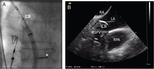 (A) The fluoroscopic image of the inflated CB in the antrum of the right superior pulmonary vein (RSPV) in a posterior–anterior view. The ICE probe has been bent backwards and pushed against the interatrial septum (*) allowing for a long-axis view. (B) The corresponding ICE view with the CB placed in the RSPV (symbolized by a black dashed line), which is not visible when the balloon is inflated due to acoustic shadowing of the balloon. Other structures useful for orientation are the right pulmonary artery (RPA), the left (LA), and the right atrium (RA).