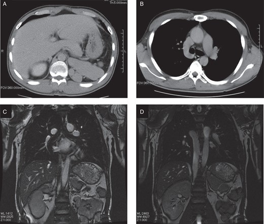 (A) Computed tomography image of the upper abdomen shows the liver, aorta, polysplenia, and absence of the inferior vena cava. (B) Abdominal venous return occurred via the collateral vein (hemiazygos vein draining into the superior vena cava). (C) Magnetic resonance image of the chest and abdomen shows the heart, liver, aorta, polysplenia, and absence of the inferior vena cava. (D) Abdominal venous return occurred via the dilated hemiazygos vein. Hypoplasia of the left kidney was noted.