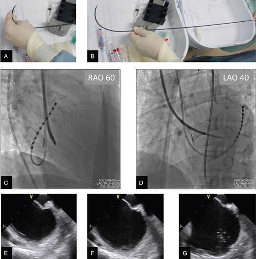 (A) A Brockenbrough needle within the dilator was manually curved to horizontally manipulate the tip toward the fossa ovalis. (B) The tip of the Brockenbrough needle then had a curve of 7 cm and a 120° angle against the proximal shaft. (C and D) Biplane fluoroscopic views during transseptal puncture procedure via the superior vena cava: (C) Images at the right anterior oblique 60° projection and (D) the left anterior oblique 40° projection demonstrate the SL3 dilator and Brockenbrough needle passing through the fossa ovalis with the tip horizontal, maintaining the relative position of the needle with the distal tip and the arrow of the proximal end oriented in the 8 o'clock position from the operator's view (leftward and posterior). To confirm the left atrial access, we injected additional contrast medium through the needle or dilator under intracardiac echocardiography and fluoroscopic guidance. (E–G) Intracardiac echocardiography views during transseptal procedure via the superior vena cava: (E) Tenting of the fossa ovalis is demonstrated by intracardiac echocardiography, which indicates that the tip of the Brockenbrough needle is located just central to the fossa ovalis. (F) Disappearance of tenting of the fossa ovalis is observed just after penetration of the tip of the Brockenbrough needle into the left atrium. (G) Injection of the contrast medium into the left atrium creates contrast echo due to microbubbles in the left atrium, and it is confirmed that the tip of the Brockenbrough needle is located in the left atrium.