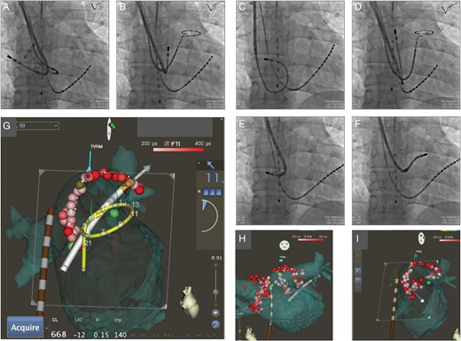 (A and B) Fluoroscopic anteroposterior images showed that the 20-pole circular mapping catheter (Lasso) is located in the right superior pulmonary vein (A) and left superior pulmonary vein (B). An 8-Fr ablation catheter with a contact force sensor (SMARTTOUCH) through the 8.5-Fr deflectable guiding sheath, 10-pole 5-Fr mapping catheter in the coronary sinus vein, and oesophageal temperature probe is also shown. (C–F) Fluoroscopic anteroposterior images showed the ablation catheter in the right superior pulmonary vein antrum (C), left superior pulmonary vein antrum (D), right inferior pulmonary vein antrum (E), and left inferior pulmonary vein antrum (F). Note that the deflectable sheath created variable curves according to each pulmonary vein antrum. (G) Merging of CARTO map with computed tomography and VISITAG (real-time automated visualization of the force–time integral) from the inner view during the ablation procedure for the left pulmonary vein and antrum. The large arrow indicates that the vector of the force at the tip of the catheter is directed perpendicularly to the endocardial tissue as an optimal direction. The real-time contact force of the tip of the ablation catheter (11 g) is indicated in the right portion of the display. VISITAG with a red colour indicates the site of ablation with an force–time integral of >400 gs. VISITAG with a pink colour indicates the site of ablation with an force–time integral of >200 gs. Definition of gradual colouring of the tag (VISITAG) is depicted at the top portion of the display as a colour scale bar ranging from 200 gs (pink) to 400 gs (red). Light green dots indicate CFAE. (H and I) Merging of CARTO map with computed tomography and VISITAG at the end of the procedure: anteroposterior views (H) and inner views (I) show that radiofrequency energy was delivered to encircle the ipsilateral pulmonary vein ostia and left atrial antrum. The oesophageal temperature probe (brown colour) and 20-pole circular mapping catheter (yellow colour) are also depicted by the advanced catheter location system.