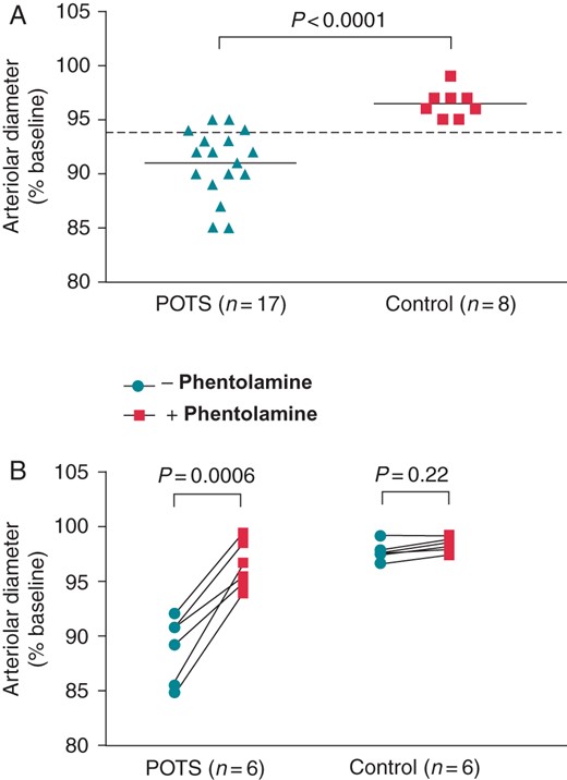 Effects of IgG (0.05 mg/mL) from POTS patients and healthy control subjects on arteriolar contractility in isolated rat cremaster arteriole assay. Values are expressed as % of buffer baseline. IgG was tested in the presence of propranolol (1 µM) and the nitric oxide synthase inhibitor L-NAME (1 µM) to eliminate any β2AR- and M3 muscarinic receptor-mediated vasodilation. Thirteen of the 17 POTS patients demonstrated significant vasoconstrictive activity compared with eight control subjects (A). No significant vasoconstriction was observed for the control subjects. The dashed line is the threshold derived from the mean contractility values—2SD of the healthy controls. The addition of the α1AR blocker phentolamine (10 µM) markedly suppressed and reversed POTS IgG-mediated contractility to control levels (B). There was no significant change in contractile activity with phentolamine for the control IgG.