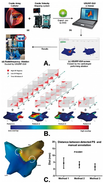 Figure I A. The workflow of using the proposed platform to guide catheter ablation: (a) NCM array and EnSite Velocity system used to collect the data; (b) information exported using DVD-RW disks to laptop running MATLAB; (c) USURP-GUI screen; (d) results exhibited to the cardiologist to help guide ablation. B. All recurrent patterns of a patient with the 2D HDF maps involved in each pattern and the corresponding time windows numbers, color-coded 3D geometry shows the overlap of all the pattern windows. C. Left: 3D phase map and its 2D representation with PS points (green circles); Right The shorted path/distances (average inter-electrode distance ∼3.5 mm) on the surface of 3D atrial mesh between PSs using manual annotation and the PSs using each method with revised thresholds.