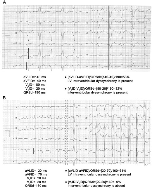 The practical application of the new ECG dyssynchrony criteria. Long vertical continuous lines denote the onset of the QRS complexes and short vertical continuous lines mark the onset of the ID, the time interval between them is time to the onset of the ID. Dashed lines mark the measurement of QRSd. Panel A: An ECG recorded in a patient with LBBB pattern is shown. With the LV intraD criterion an ED+ diagnosis is made, as its value is 53% (i.e. >25%). With the interD criterion also an ED+ diagnosis is established, as its value is 32% (i.e.>25%).When the two new ECG dyssynchrony criteria are applied together, a final ED+ diagnosis is made, if at least one of them indicates ED+ diagnosis. If both indicate ED− diagnosis, a final ED− diagnosis is made. Thus, using the two new ECG dyssynchrony criteria together predicted this patient as an expected R. Panel B: An ECG recorded in a patient with NICD pattern is shown. Since in lead V1 a QS complex is present, therefore we measured V2ID instead of V1ID. With the LV intraD criterion an ED+ diagnosis is made, as its value is 31% (i.e. >25%), with the interD criterion an ED− diagnosis is made, as its value is 0% (i.e. ≤25%). Thus, this patient is an expected R applying the two dyssynchrony criteria together.