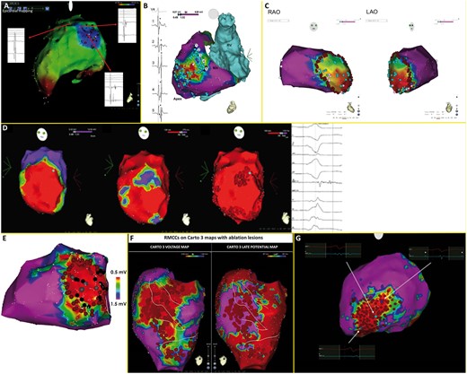 Strategies for substrate modification of studies included (A) local abnormal ventricular activities, (B) scar dechanneling, (C) substrate isolation, (D) late potentials, (E) core isolation, (F) ripple mapping conduction channels, (G) scar homogenization. Adapted from Jais et al.5, Vergara et al.7, Tilz et al.13, Berruezo et al.9, Tzou et al.12, Jamil-Copley et al.14, Gokoglan et al.15