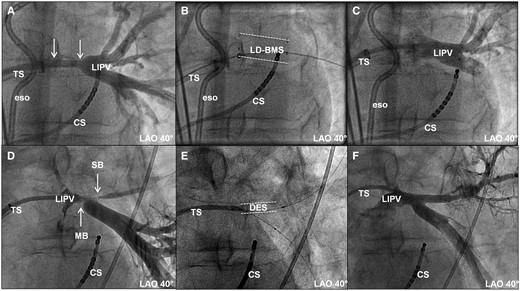 Examples of high-grade PV stenoses in left inferior pulmonary veins. (A–C) Stenosis proximal to PV bifurcation (Patient 15) and (D–F) stenoses in PV bifurcation (Patient 7). (A) Angiographic image after predilatation and before stent implantation. Arrows indicate length of stenosis. (B) Fluoroscopic image after implantation of large-diameter bare metal stent (LD-BMS; dashed lines). (C) Angiographic image post-stenting. (D) Angiographic image after predilatation and before stent implantation in bifurcation lesion. Arrows indicate two stenoses, one in the main branch (MB) and one in the side branch (SB). (E) Fluoroscopic image after implantation of DES into both branches and kissing-balloon dilatation. DES in side branch marked by dashed lines. (F) Final angiographic image. CS, coronary sinus; eso, oesophageal temperature probe; LAO, left anterior oblique view; LIPV, left inferior pulmonary vein; TS, trans-septal sheath/multipurpose catheter.