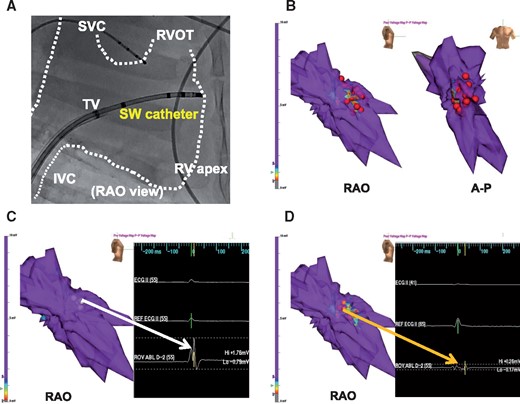 Functional electrophysiological effectiveness of SWCA. (A) Fluoroscopic image of SW catheter position at SW applications inside the right ventricle. IVC, inferior vena cava; RAO, right anterior oblique; RVA, right ventricular apex; RVOT, right ventricular outflow; SVC, superior vena cava; TA, tricuspid annulus. (B) Shock wave of 1440 shots was applied in the RV anterior wall so that it caused cluster-like area by dragging method. Red tags indicate application points. Grey area shows <0.5 mV as injured area, red–blue area 0.5–1.5 mV as border zone, and purple area ≥ 1.5 mV as normal tissue. (C) Representative endocardial voltage map at baseline showed normal tissue (≥1.5 mV as purple) and a normal amplitude electrogram (1.76 mV) in a target region (white arrow). (D) Representative post-SWCA voltage map showed low-voltage area (<1.5 mV as area from red to dark blue) and a low-amplitude electrogram (0.26 mV) in a target region (orange arrow).