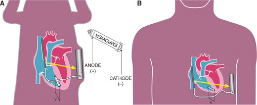 Detection of the coded signal by the anode (+) and cathode (−) of the LP. The voltage difference (v) detected by the LP is affected by the position of the LP towards the communication vector (yellow arrow). (A) Canine model with a relative small angle of the LP towards the communication vector. (B) Human model with a relative larger angle of the LP towards the communication vector. LP, leadless pacemaker.